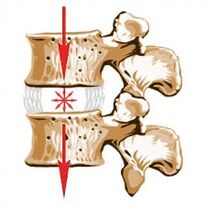 Naprava hrbtenice in vzroki za osteohondrozo