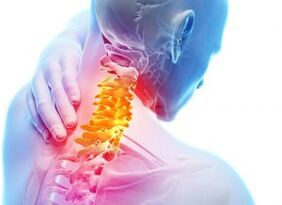 Bolečina in streljanje v predelu materničnega vratu z osteohondrozo tretje stopnje