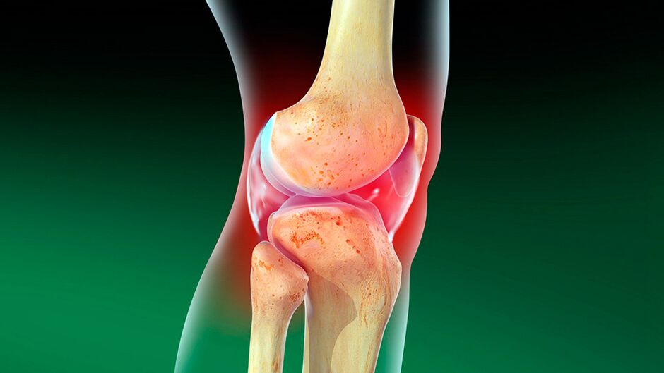 Osteoartritis kolenskega sklepa